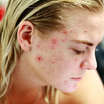 What Causes Acne?