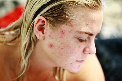 What Causes Acne?