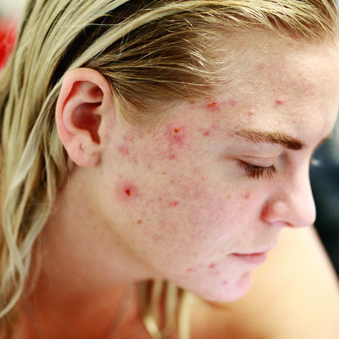 Blonde woman struggling with acne looking down